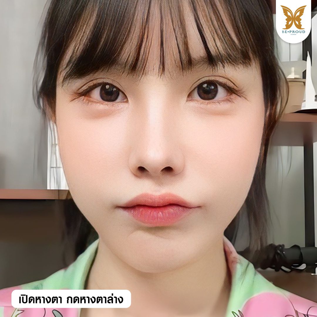 ผลลัพธ์ตาสองชั้น เปิดหางตา