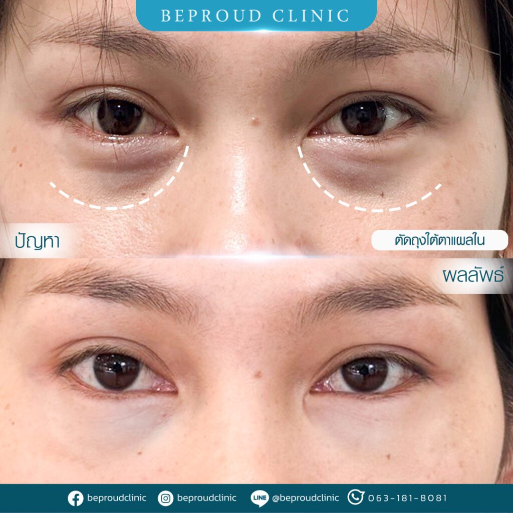 ถุงใต้ตา