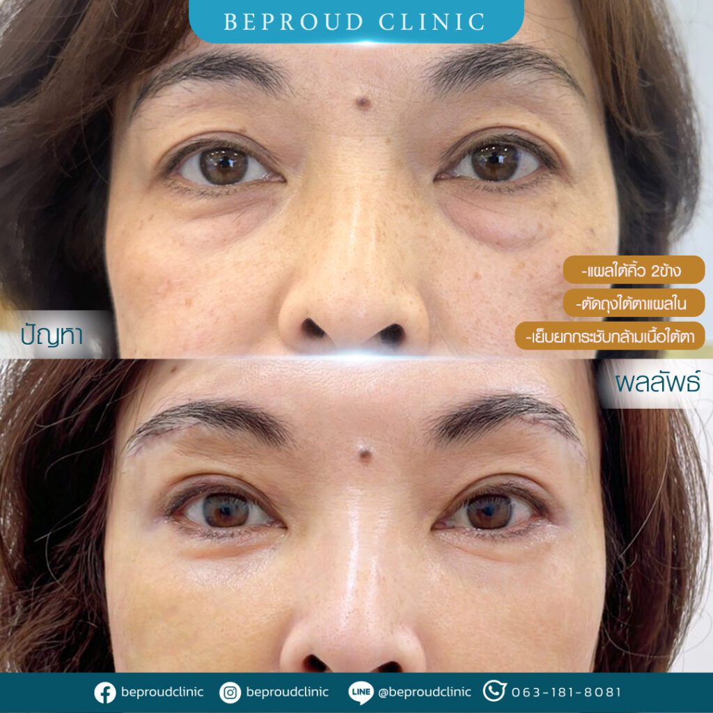 ถุงใต้ตา