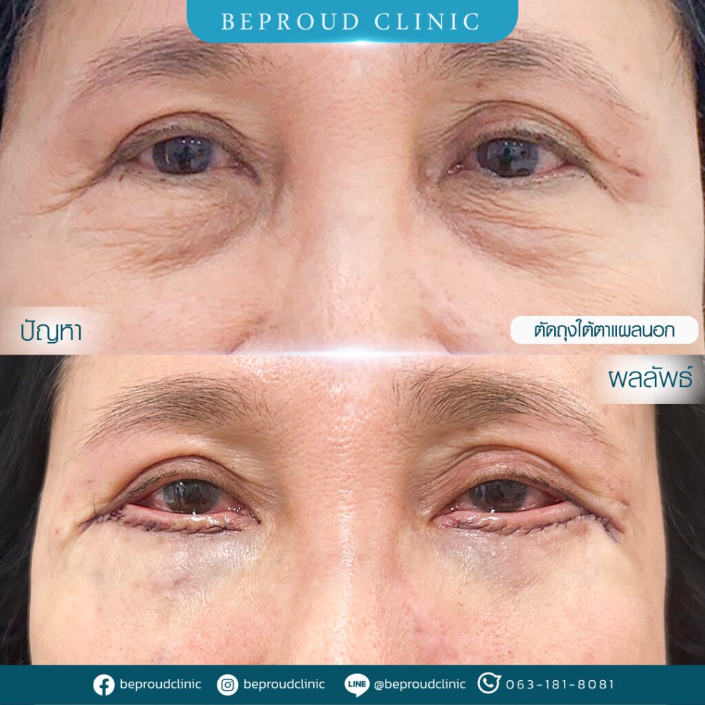 ถุงใต้ตา