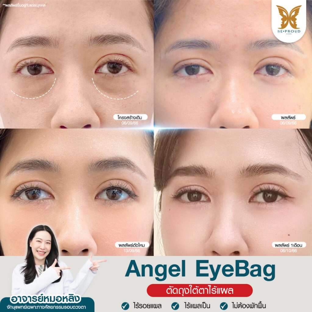 ถุงใต้ตา