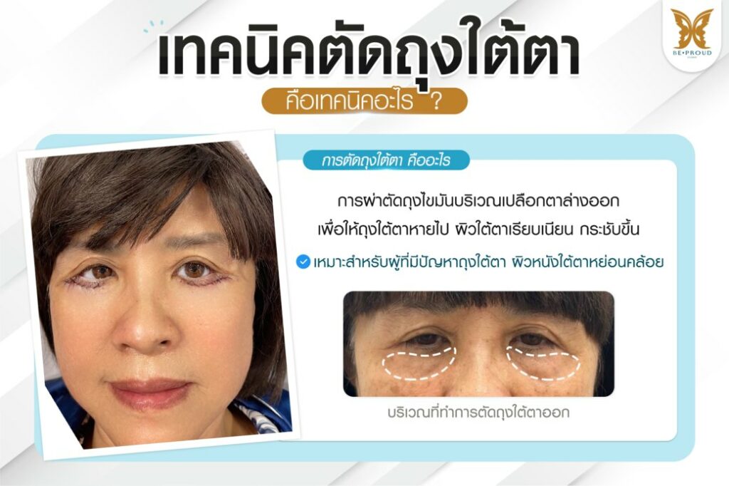 หนังตาตก ถุงใต้ตา วัยกลางคน ผู้สูงอายุ