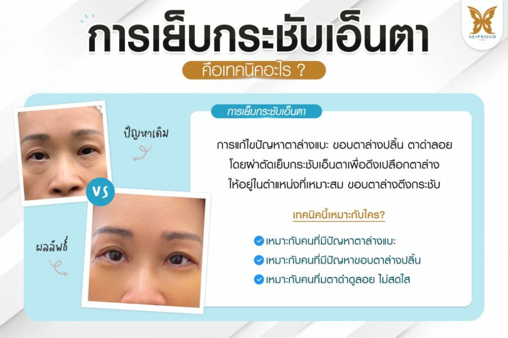 หนังตาตก ถุงใต้ตา วัยกลางคน ผู้สูงอายุ