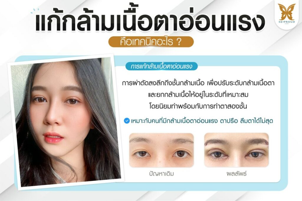 หนังตาตก ถุงใต้ตา วัยกลางคน ผู้สูงอายุ