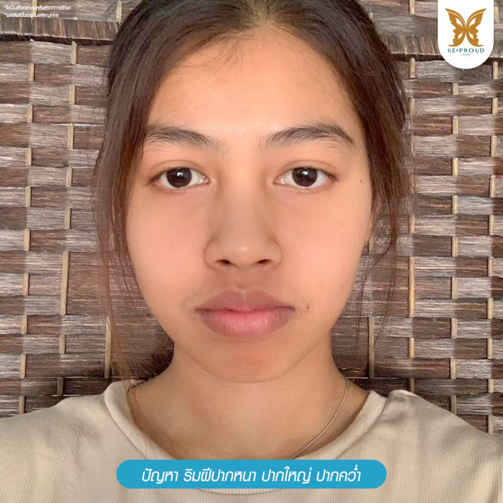 ปากกระจับ ศัลยกรรมปากกระจับ ฟิลเลอร์ปาก