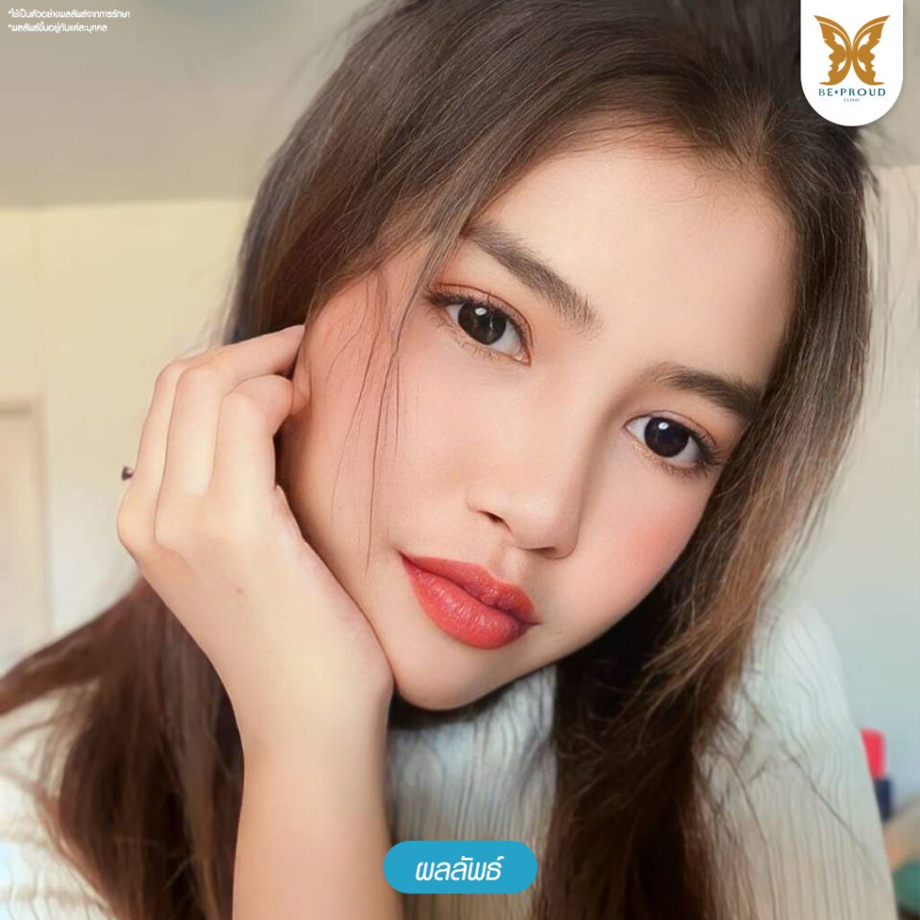 ปากกระจับ ศัลยกรรมปากกระจับ ฟิลเลอร์ปาก