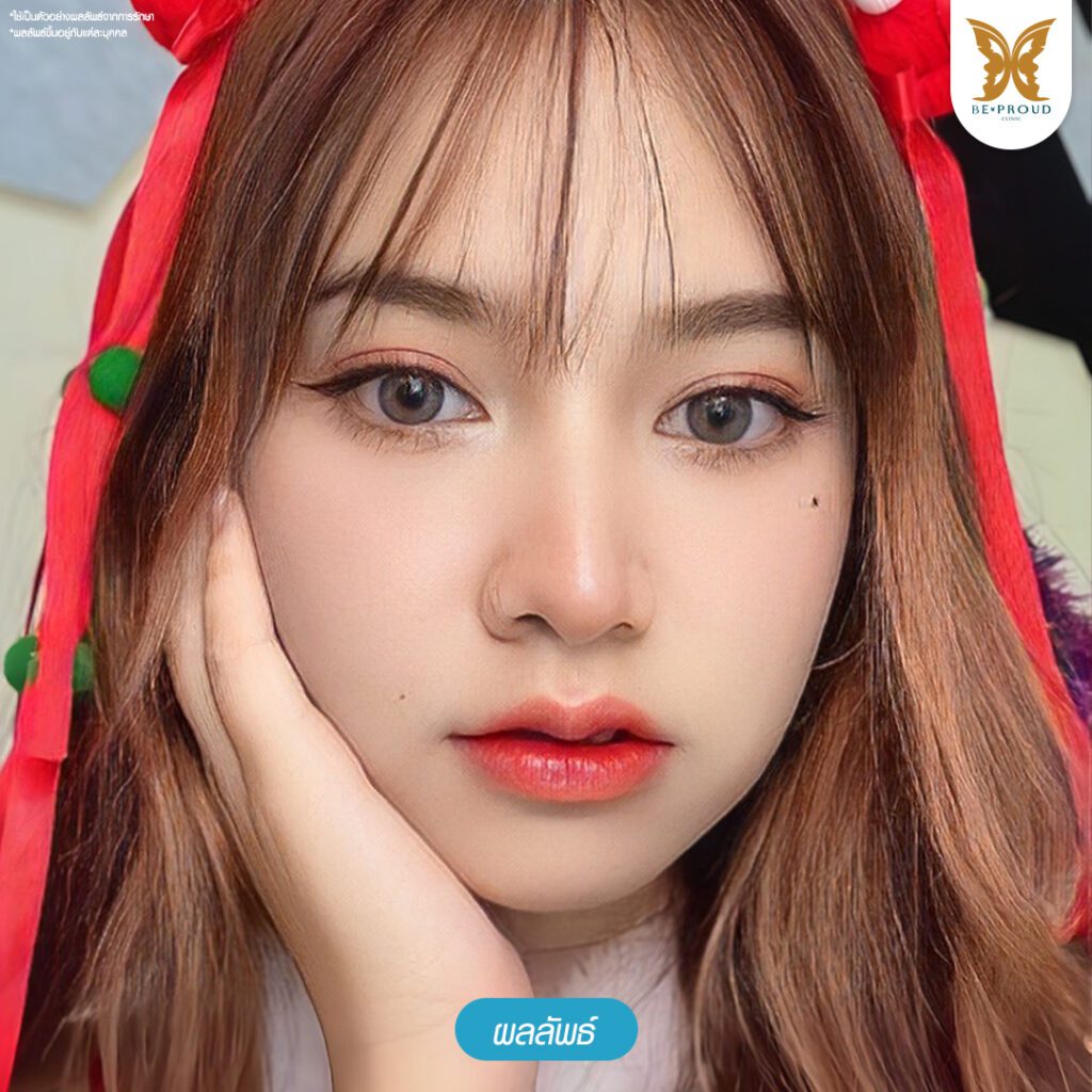 ปากกระจับ ศัลยกรรมปากกระจับ ฟิลเลอร์ปาก