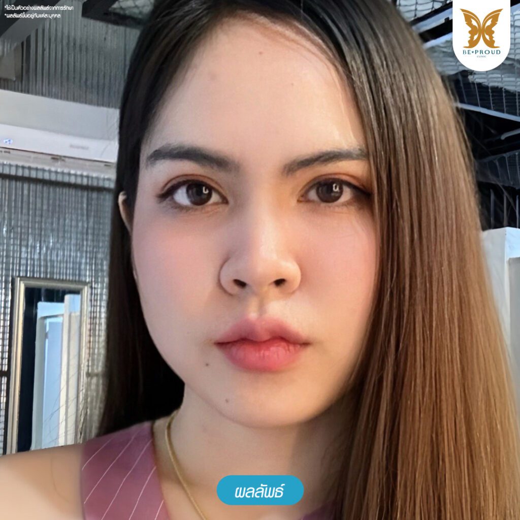 ปากกระจับ ศัลยกรรมปากกระจับ ฟิลเลอร์ปาก