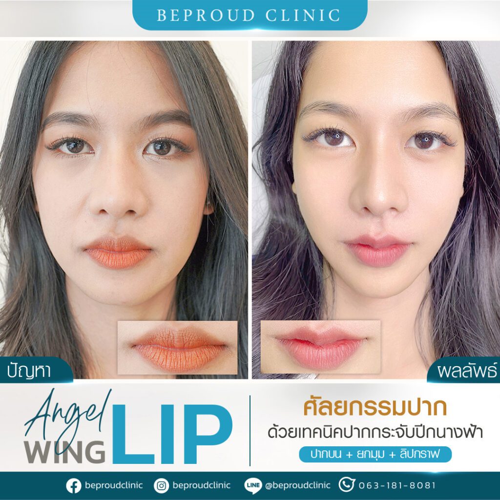 ปากกระจับ