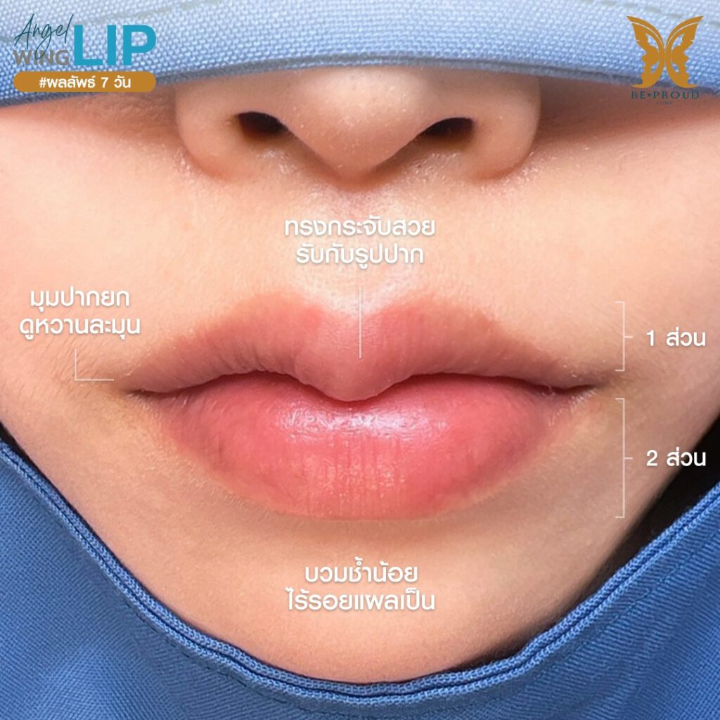 ปากกระจับ ศัลยกรรมปากกระจับ ฟิลเลอร์ปาก