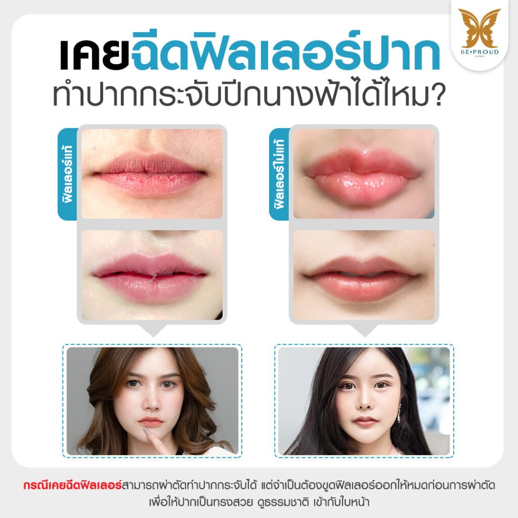 ปากกระจับ ศัลยกรรมปากกระจับ ฟิลเลอร์ปาก