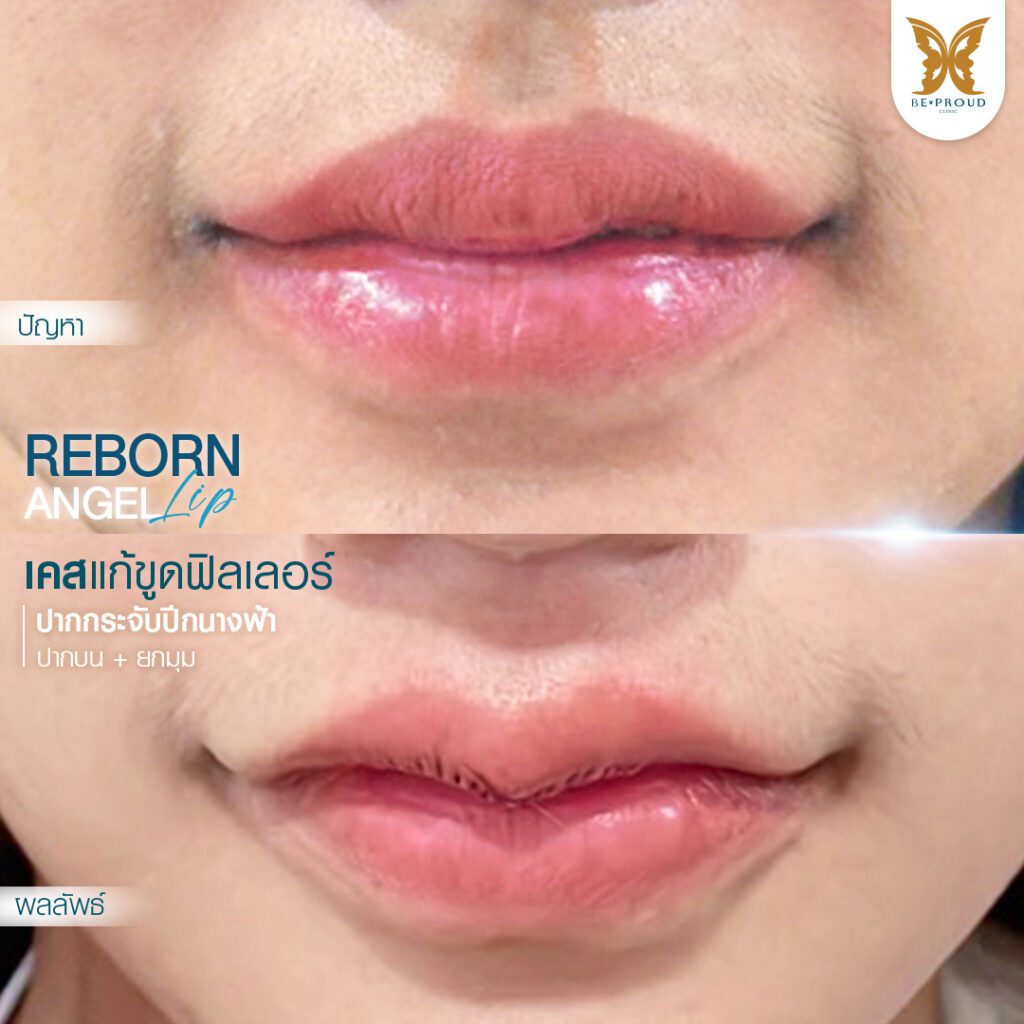 ปากกระจับ ศัลยกรรมปากกระจับ ฟิลเลอร์ปาก