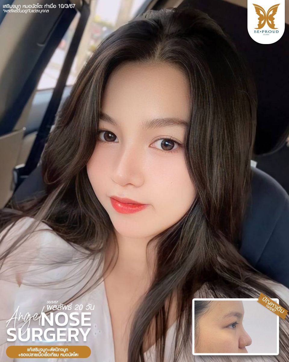 เสริมจมูก เสริมจมูกครั้งแรก ศัลยกรรมจมูกทรงจมูก
