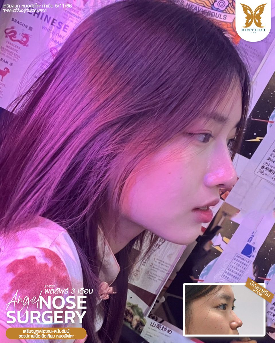 เสริมจมูก เสริมจมูกครั้งแรก ศัลยกรรมจมูกทรงจมูก