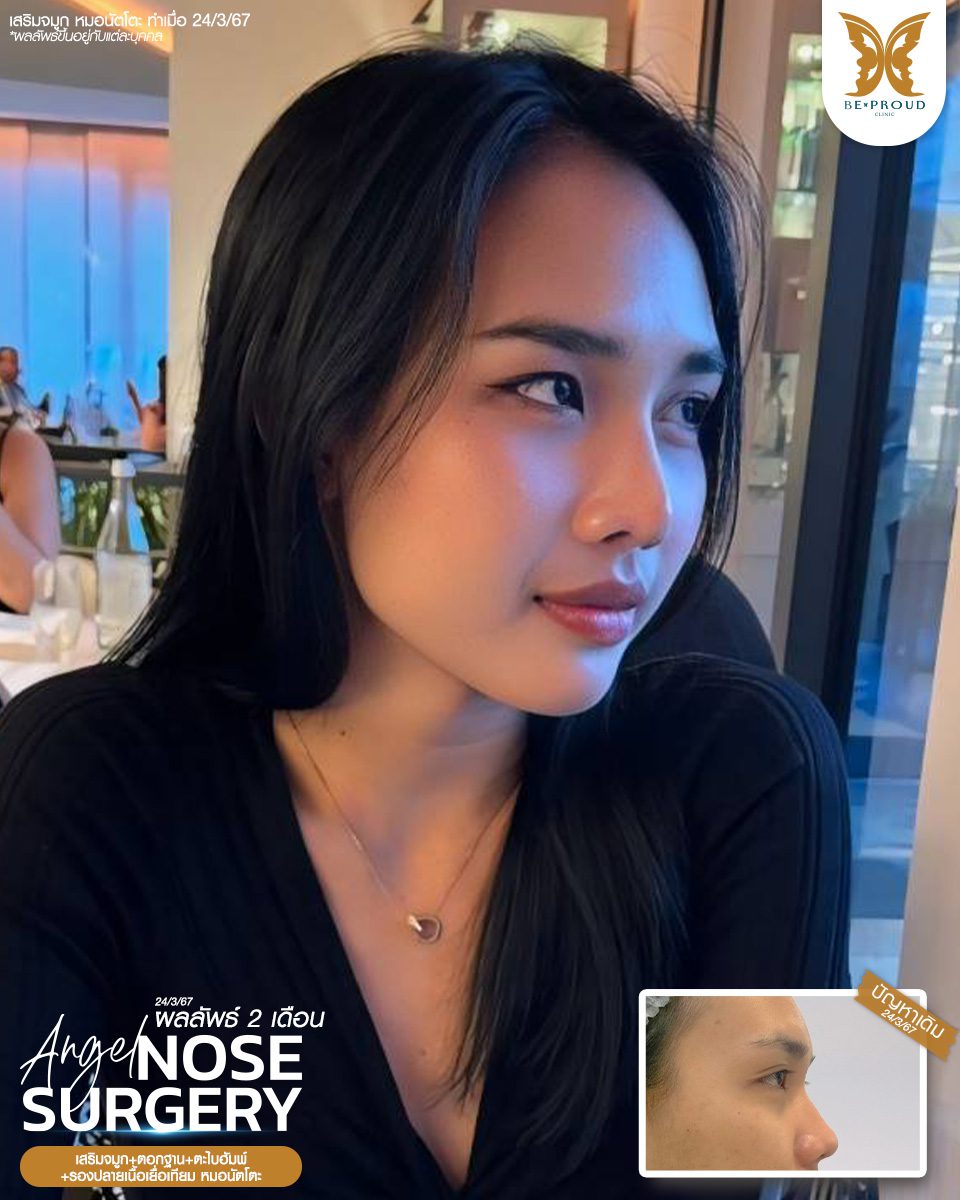 เสริมจมูก เสริมจมูกครั้งแรก ศัลยกรรมจมูกทรงจมูก