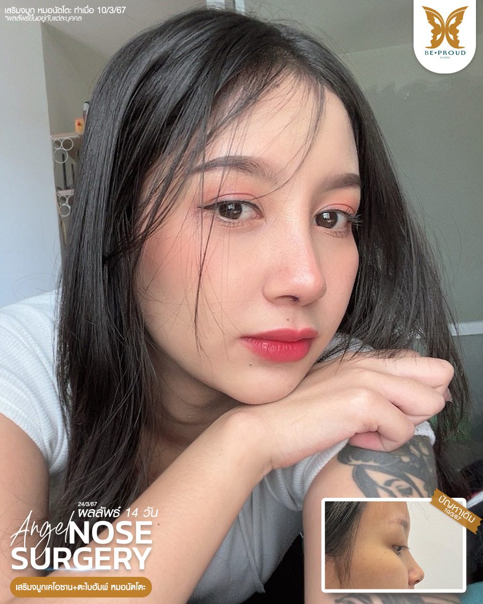 เสริมจมูก เสริมจมูกครั้งแรก ศัลยกรรมจมูกทรงจมูก