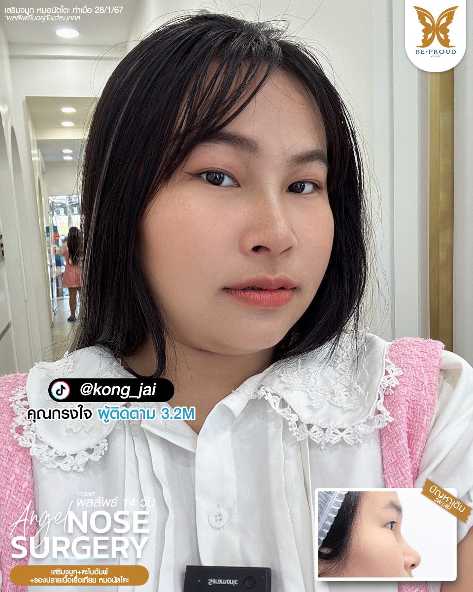 เสริมจมูก เสริมจมูกครั้งแรก ศัลยกรรมจมูกทรงจมูก