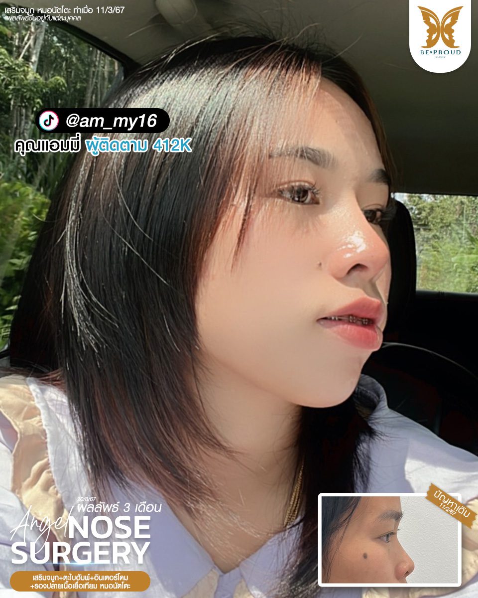 เสริมจมูก เสริมจมูกครั้งแรก ศัลยกรรมจมูกทรงจมูก