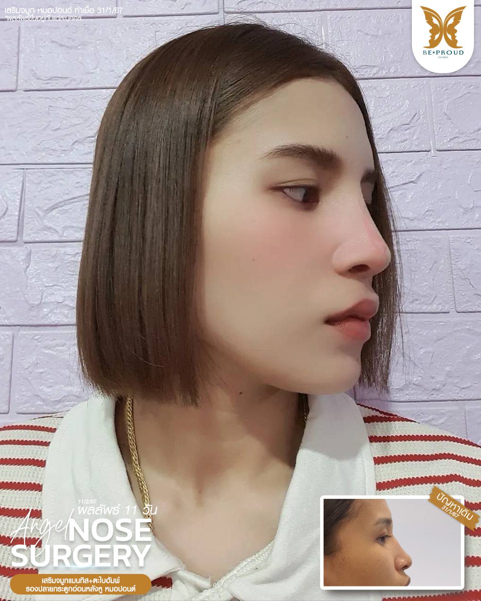 เสริมจมูก เสริมจมูกครั้งแรก ศัลยกรรมจมูกทรงจมูก