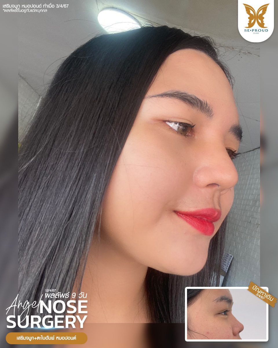 เสริมจมูก เสริมจมูกครั้งแรก ศัลยกรรมจมูกทรงจมูก