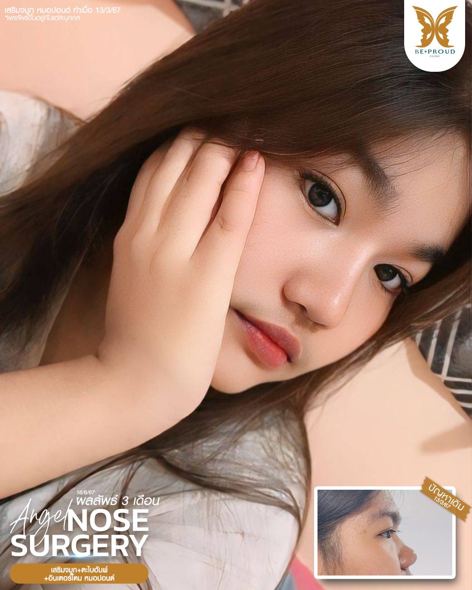 เสริมจมูก เสริมจมูกครั้งแรก ศัลยกรรมจมูกทรงจมูก