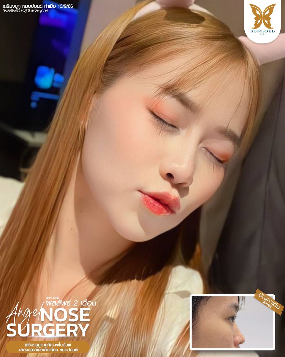 เสริมจมูก เสริมจมูกครั้งแรก ศัลยกรรมจมูกทรงจมูก