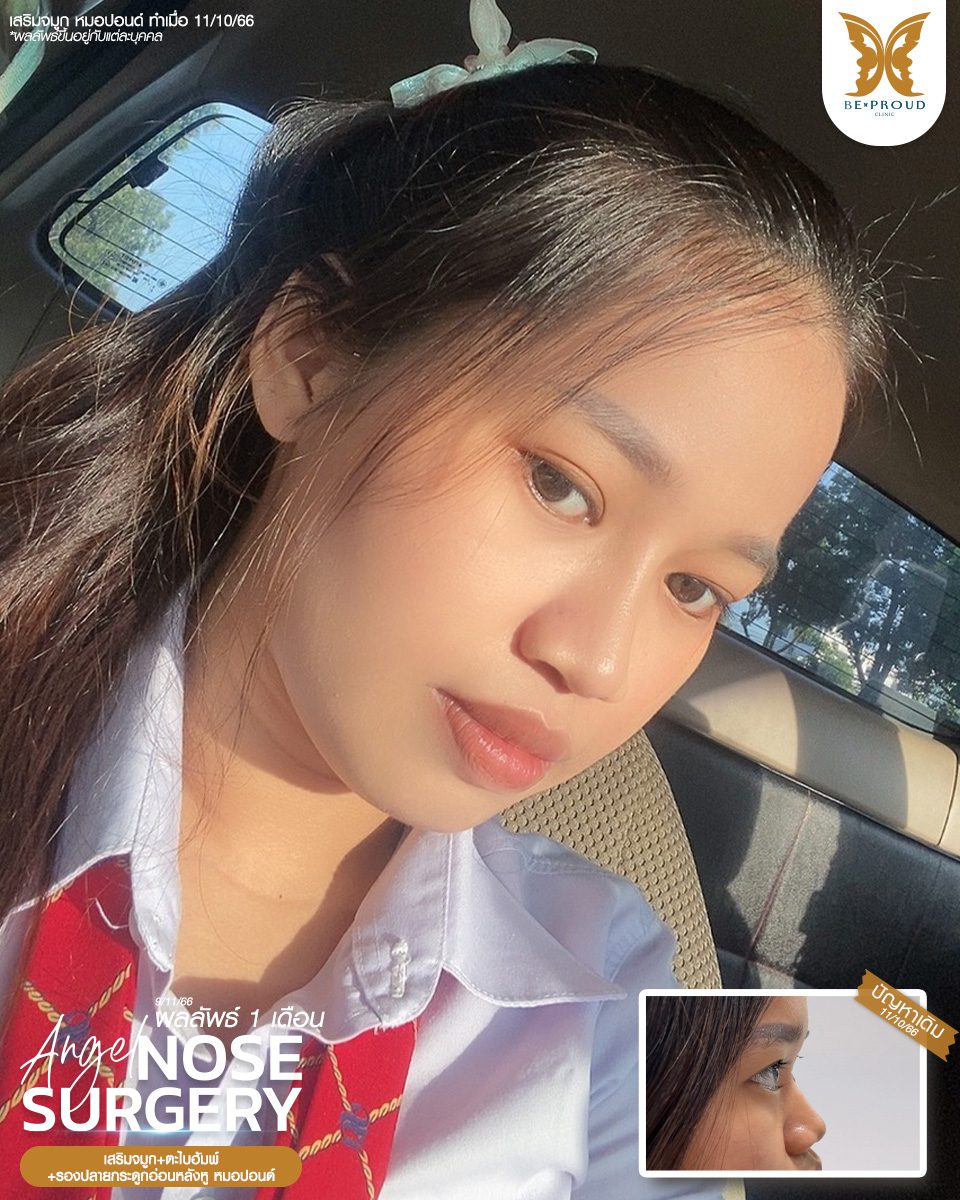 เสริมจมูก เสริมจมูกครั้งแรก ศัลยกรรมจมูกทรงจมูก