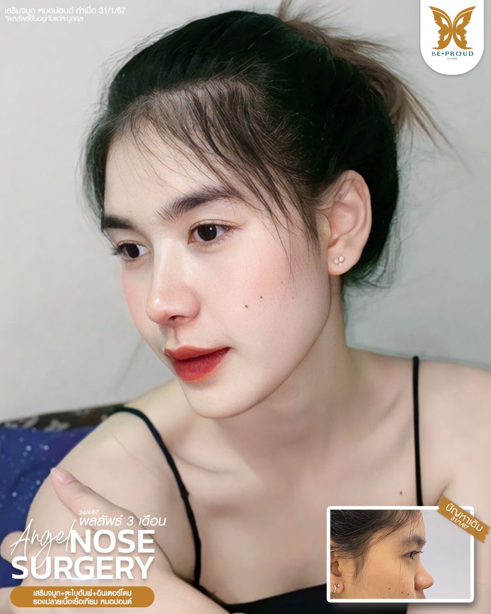 เสริมจมูก เสริมจมูกครั้งแรก ศัลยกรรมจมูกทรงจมูก