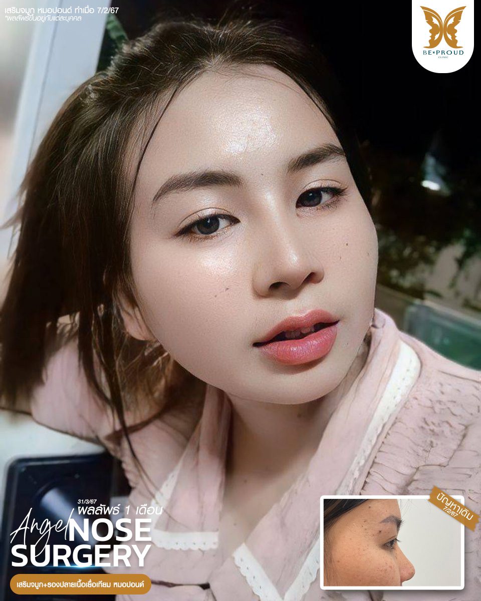 เสริมจมูก เสริมจมูกครั้งแรก ศัลยกรรมจมูกทรงจมูก