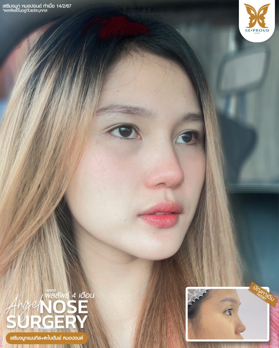 เสริมจมูก เสริมจมูกครั้งแรก ศัลยกรรมจมูกทรงจมูก