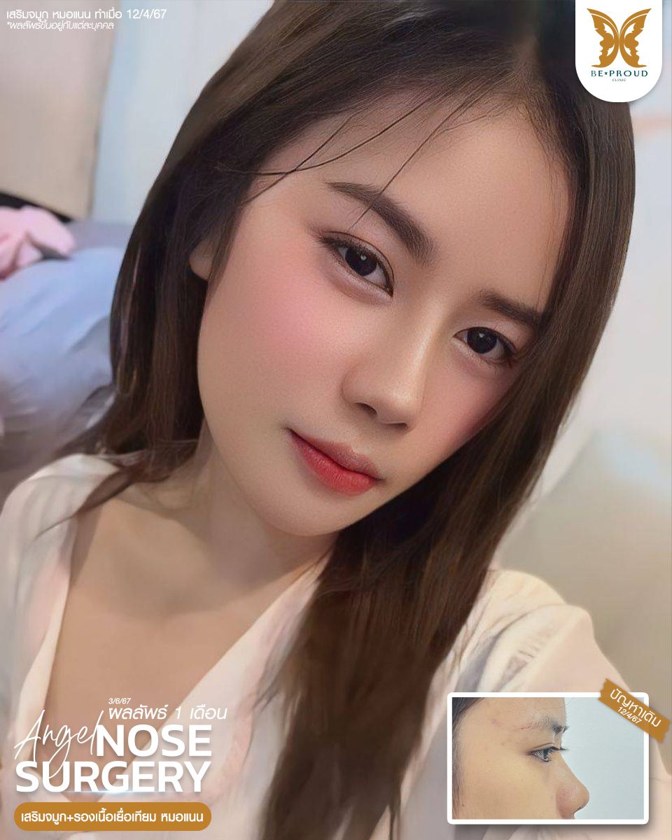 เสริมจมูก เสริมจมูกครั้งแรก ศัลยกรรมจมูกทรงจมูก