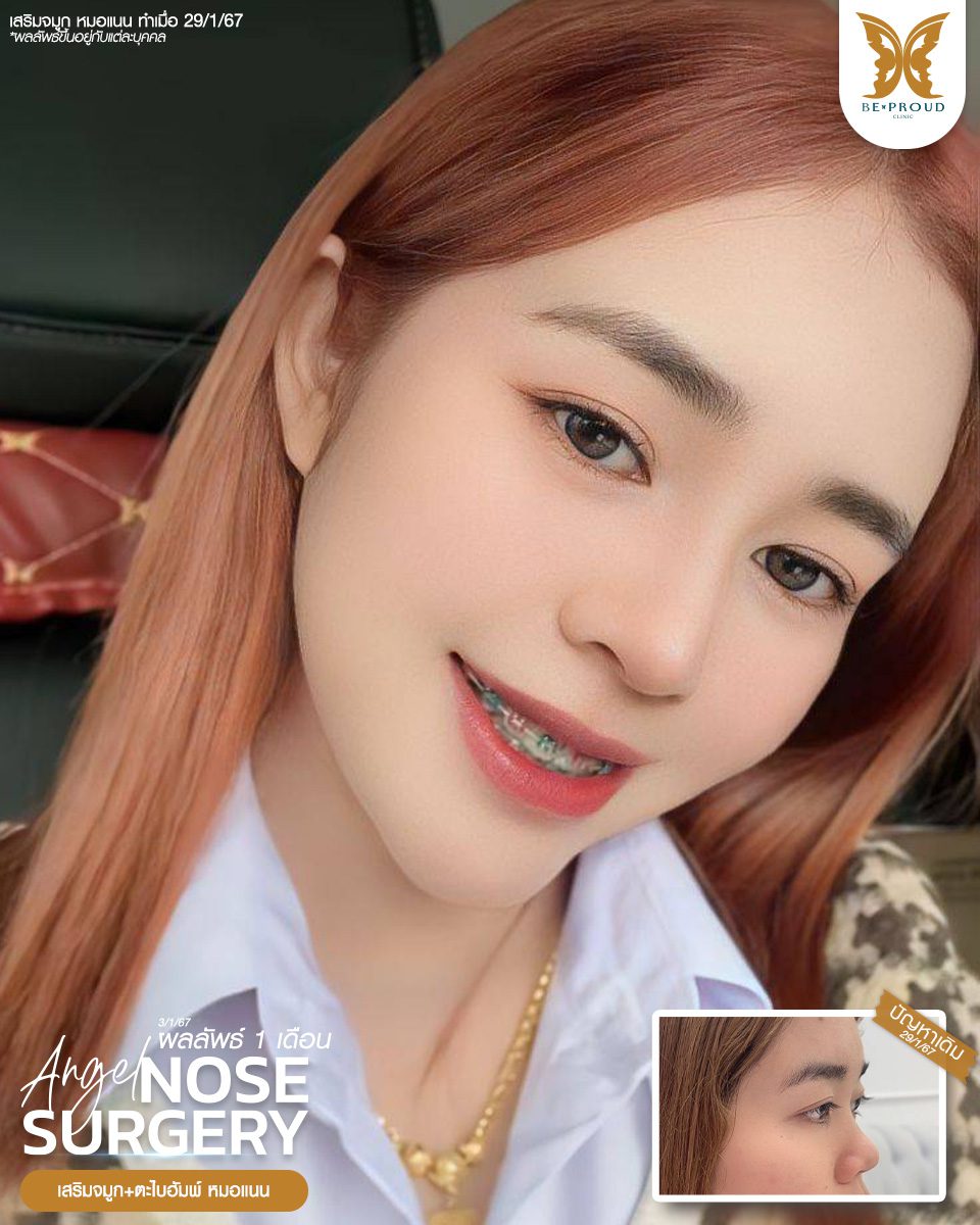 เสริมจมูก เสริมจมูกครั้งแรก ศัลยกรรมจมูกทรงจมูก