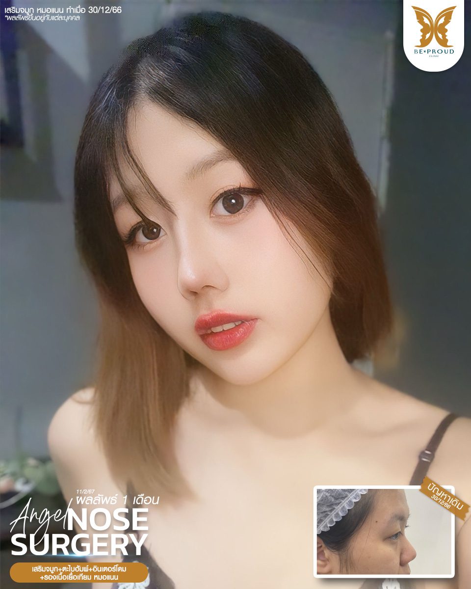 เสริมจมูก เสริมจมูกครั้งแรก ศัลยกรรมจมูกทรงจมูก