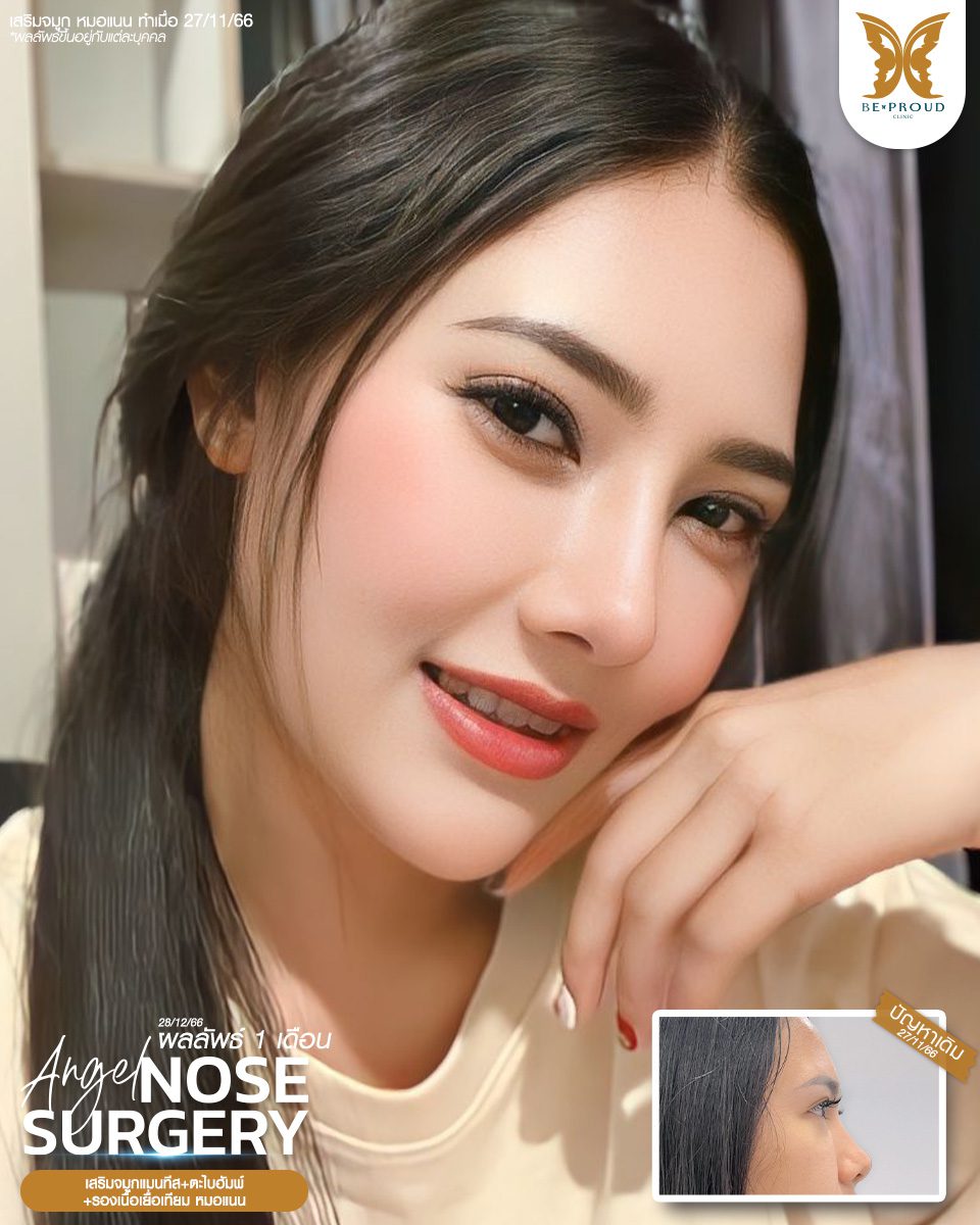 เสริมจมูก เสริมจมูกครั้งแรก ศัลยกรรมจมูกทรงจมูก