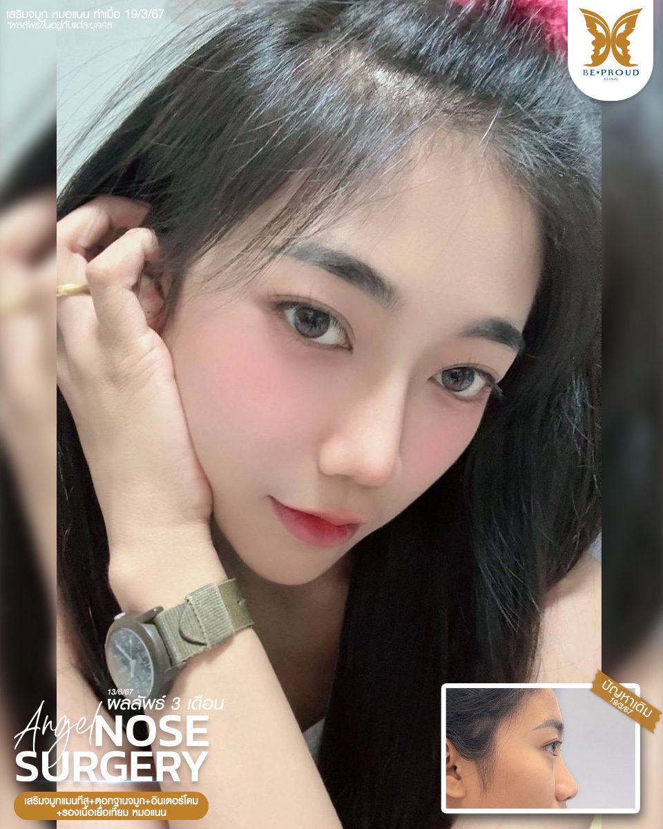 เสริมจมูก เสริมจมูกครั้งแรก ศัลยกรรมจมูกทรงจมูก