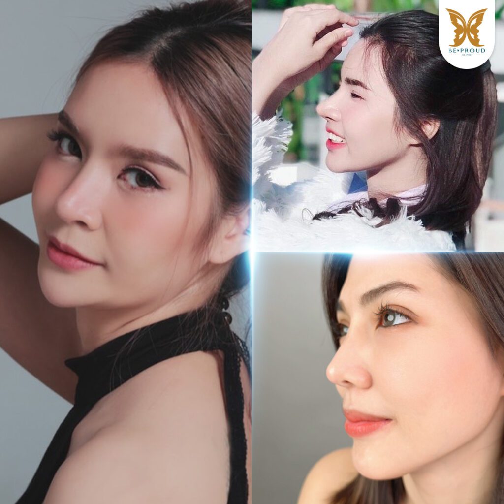 เสริมจมูก เสริมจมูกครั้งแรก ศัลยกรรมจมูกทรงจมูก