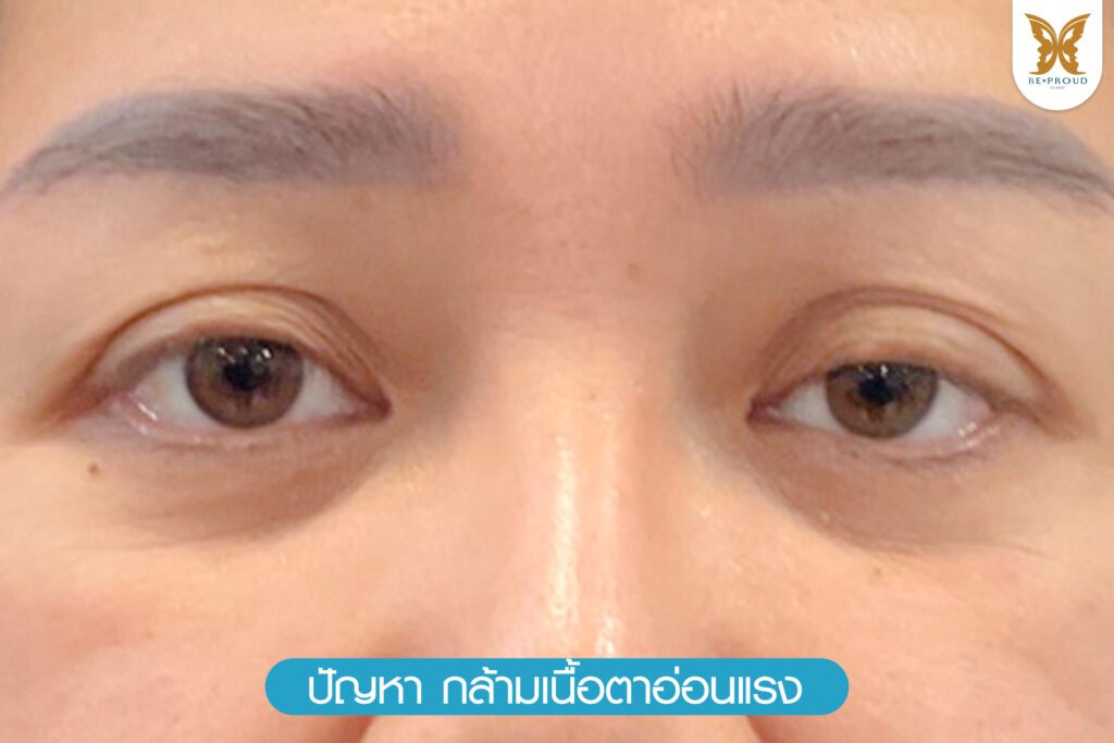 หนังตาตก ถุงใต้ตา วัยกลางคน ผู้สูงอายุ