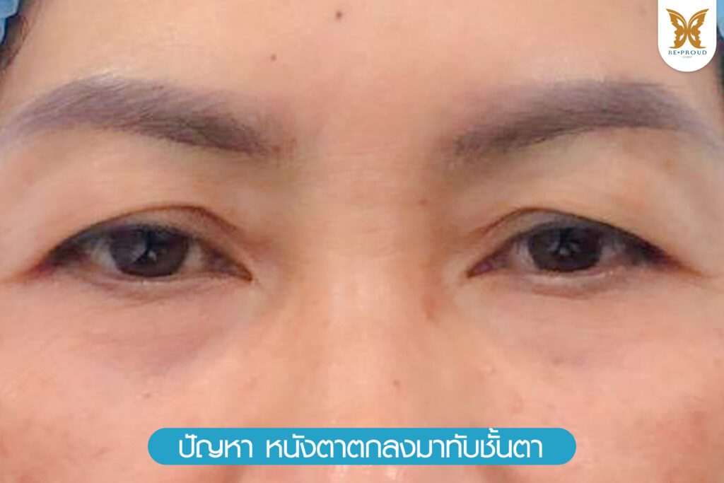 หนังตาตก ถุงใต้ตา วัยกลางคน ผู้สูงอายุ