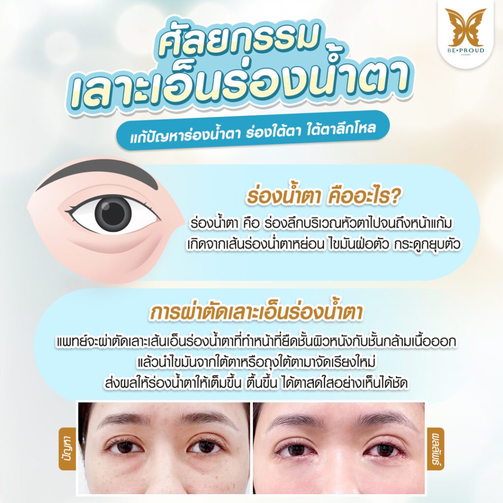 หนังตาตก ถุงใต้ตา วัยกลางคน ผู้สูงอายุ