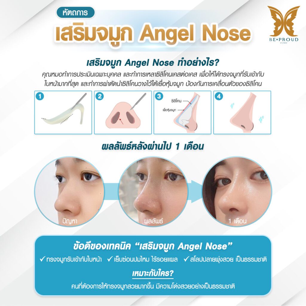 เสริมจมูก เสริมจมูกครั้งแรก ศัลยกรรมจมูกทรงจมูก