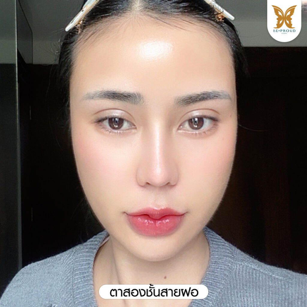 ตาสองชั้น ชั้นตาเล็ก ตาสองชั้นแบบธรรมชาติ