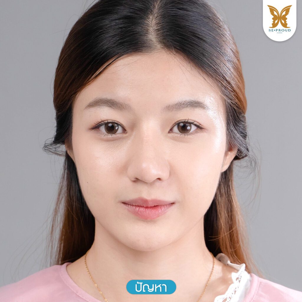 ตาสองชั้น ชั้นตาเล็ก ตาสองชั้นแบบธรรมชาติ