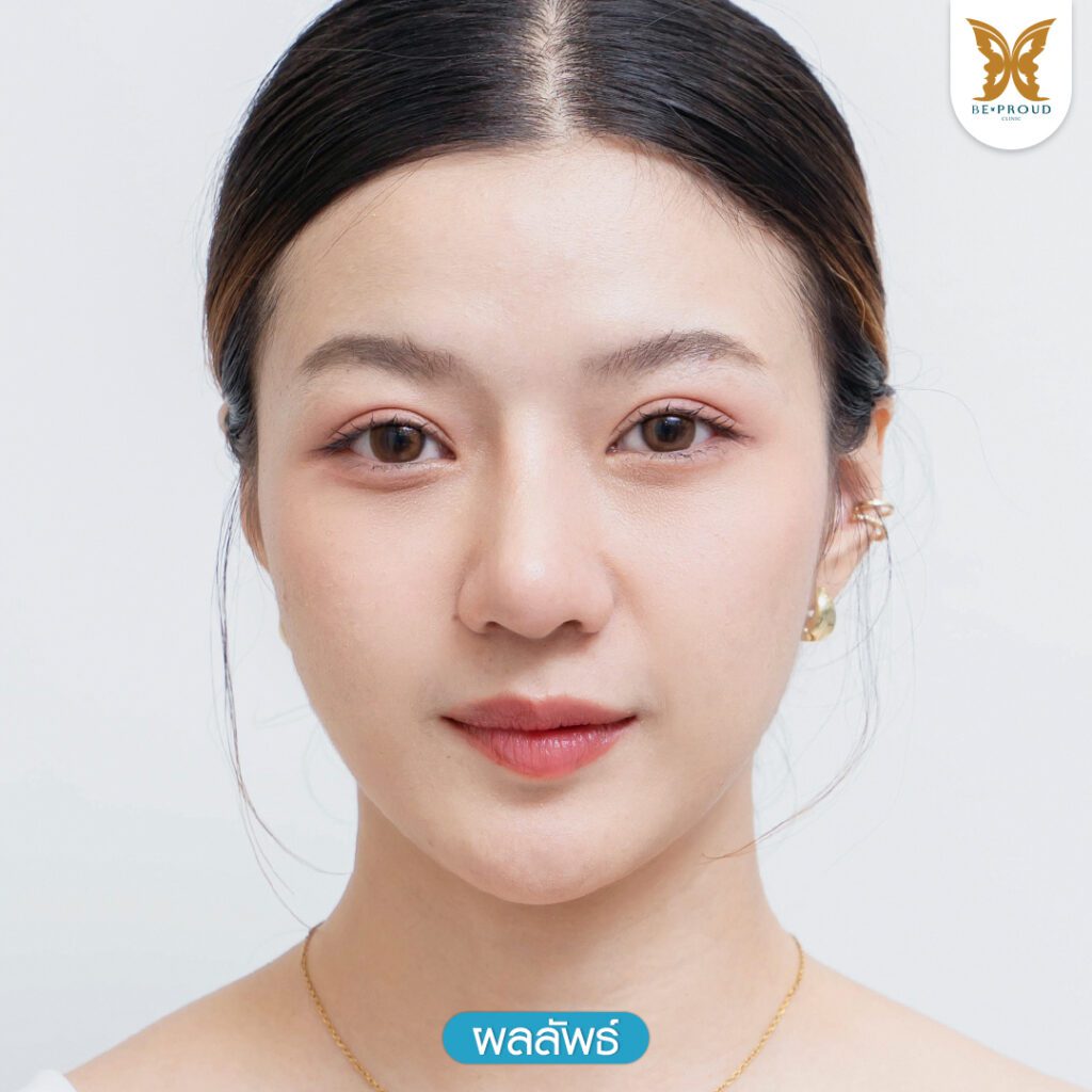 ตาสองชั้น ชั้นตาเล็ก ตาสองชั้นแบบธรรมชาติ