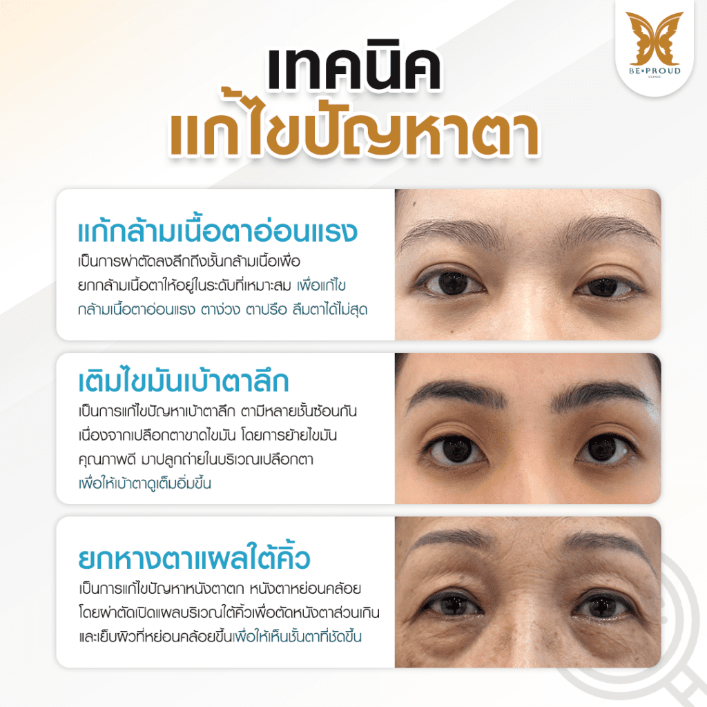 เทคนิคพิเศษตา หมอหลิง