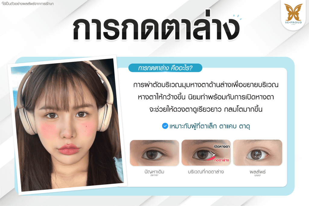 เทคนิคพิเศษตา หมอหลิง