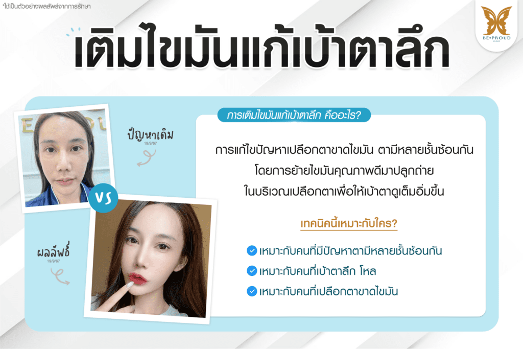 เทคนิคพิเศษตา หมอหลิง