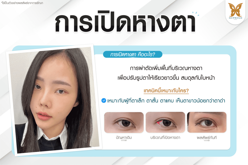 เทคนิคพิเศษตา หมอหลิง