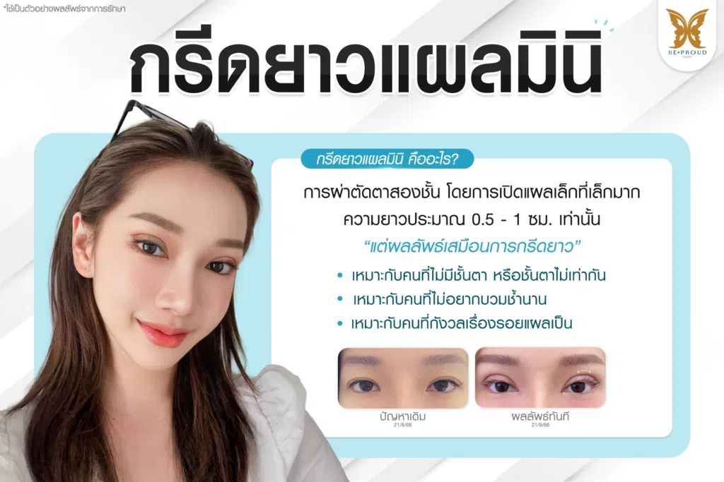 เทคนิคพิเศษตา กรีดยาวแผลมินิ