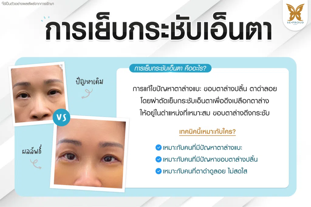 เทคนิคพิเศษตา หมอหลิง