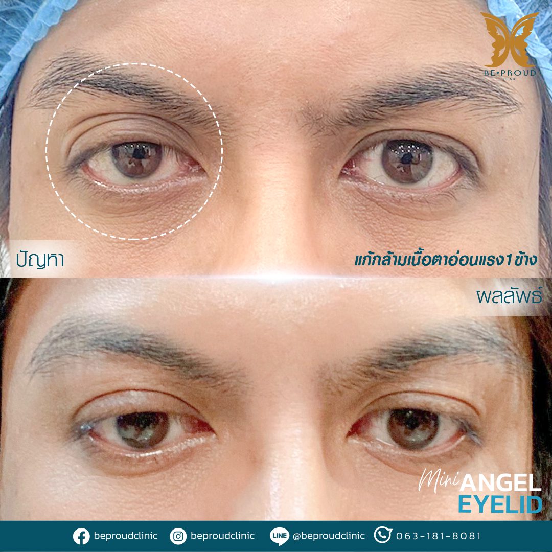 กล้ามเนื้อตาอ่อนแรง